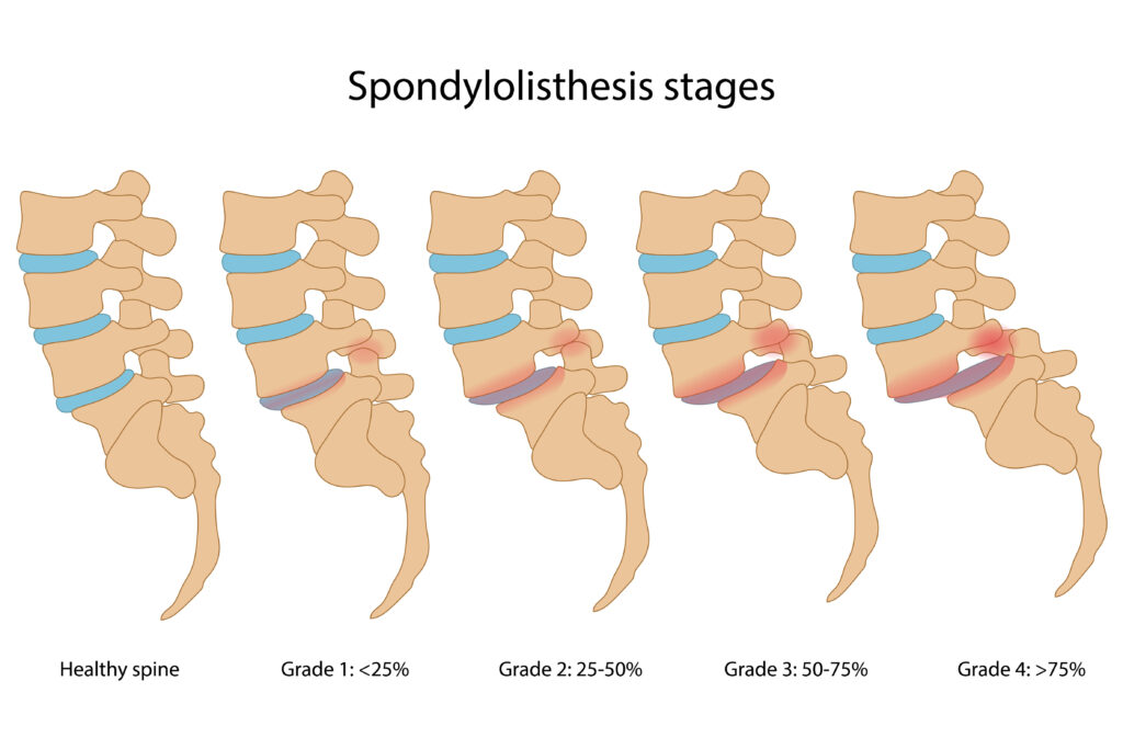 Posuny obratlů (Spondylolistéza)